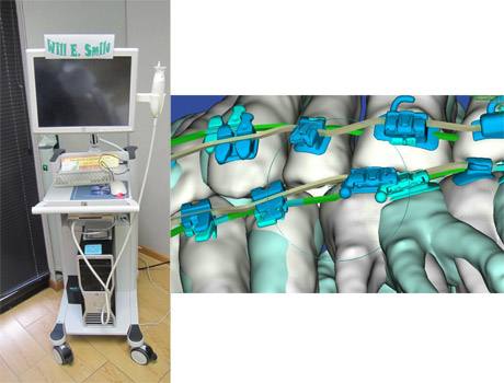 Suresmile Scanner.
Suresmile utilizes proprietary scanning technology to enable orthodontist to visually define the desired position of a patient’s teeth, and helps to calculate all of the customization needed to deliver the doctor’s plan. Dr. Razdolsky’s treatment plan customization is then precisely translated to each patient’s archwires by Suresmile robots, which cuts treatment time by about a third while also improving the quality of treatment results.
